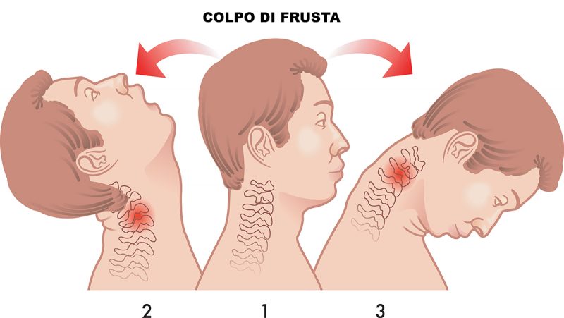 Colpo di frusta